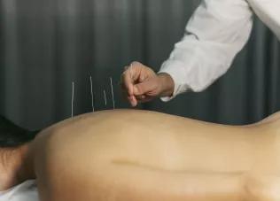 acupuncture