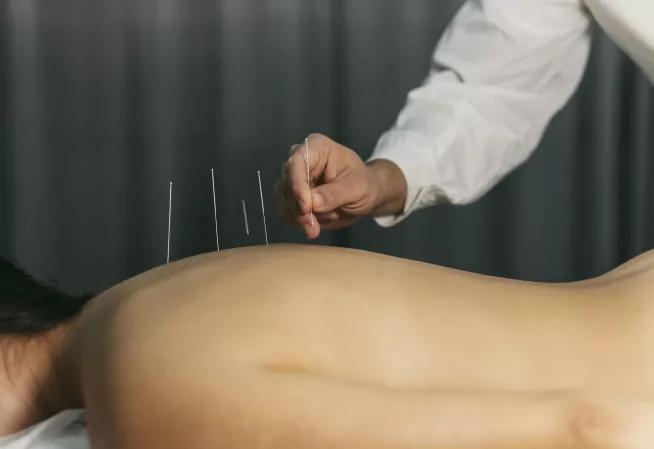 acupuncture